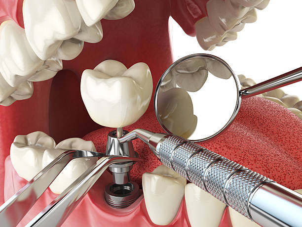 Best Emergency Dental Care for Broken or Chipped Teeth in Medina, NY